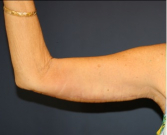 Feel Beautiful - Arm Reduction 207 - After Photo